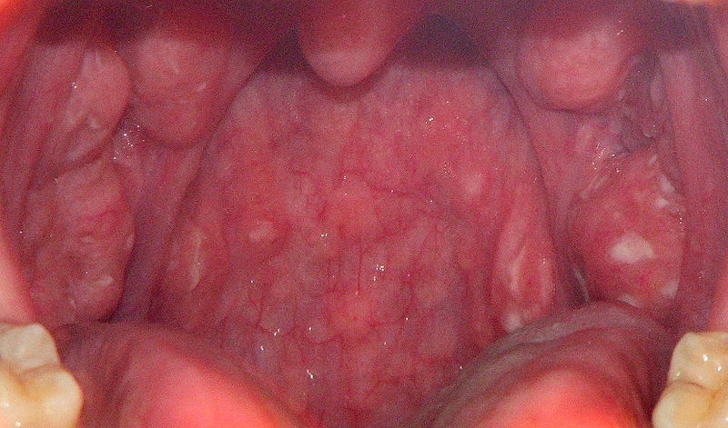 throat yeast infection
